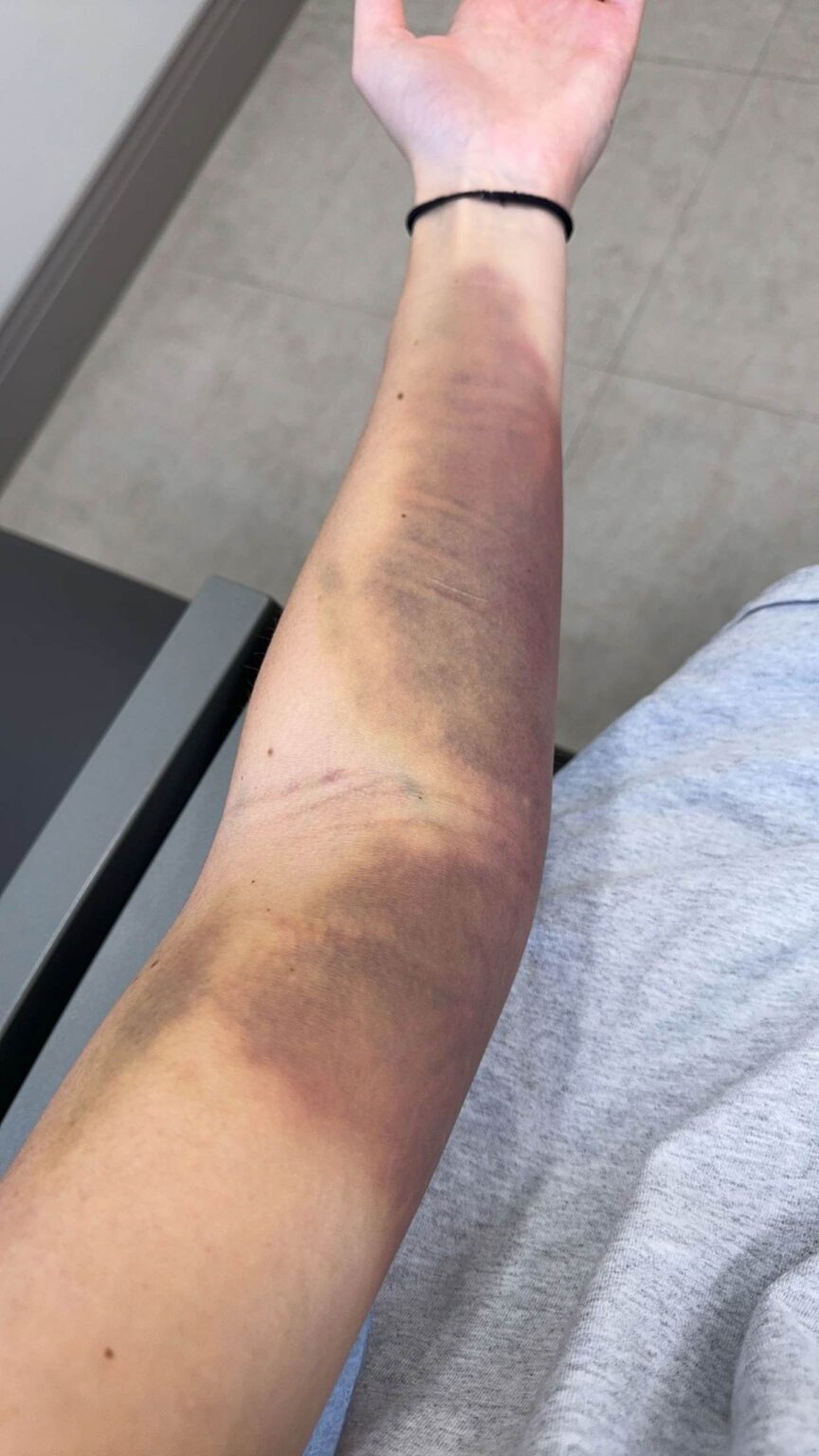 SPECIAL REPORT Experts warn giving too much plasma can be dangerous